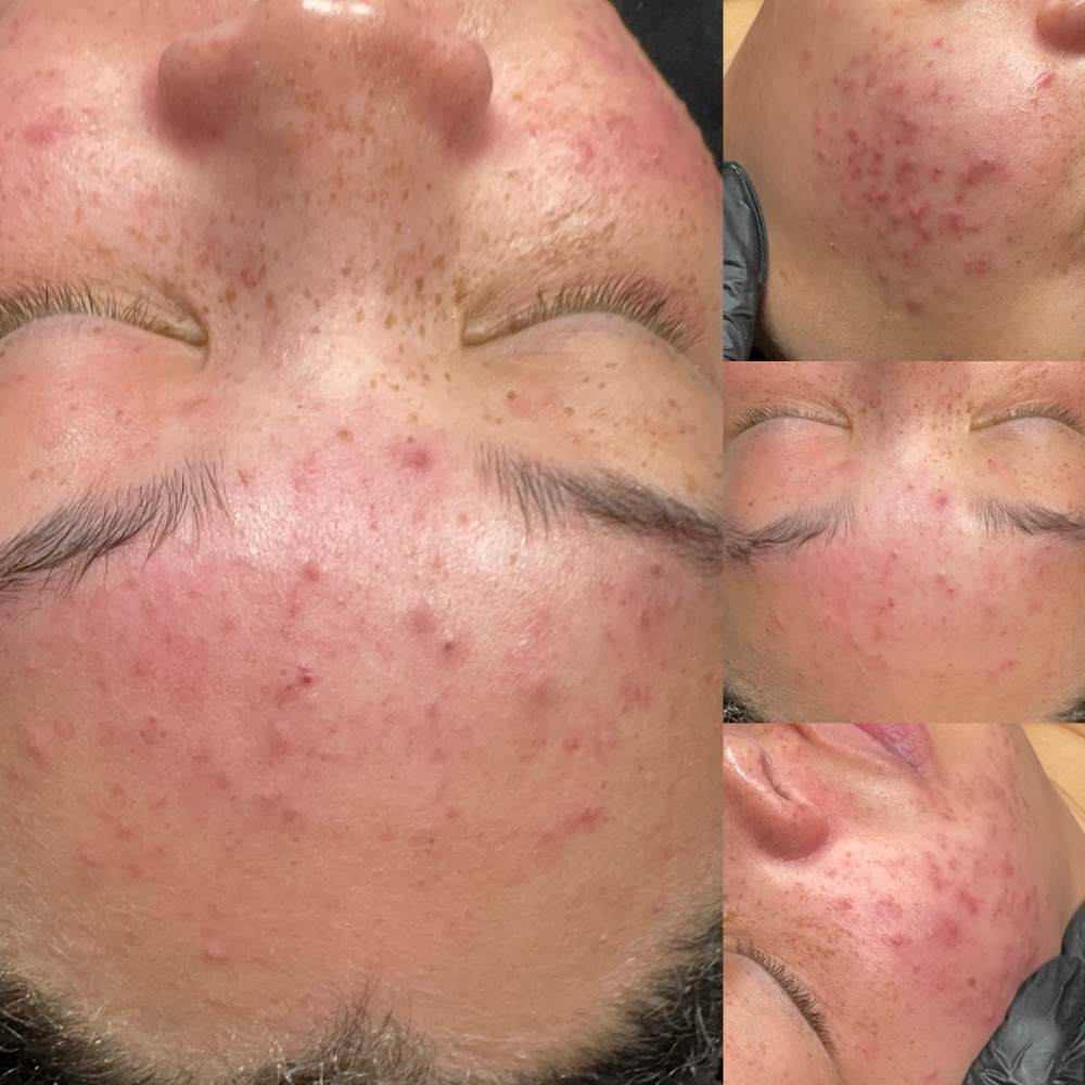 Deep Detox Acne Facial