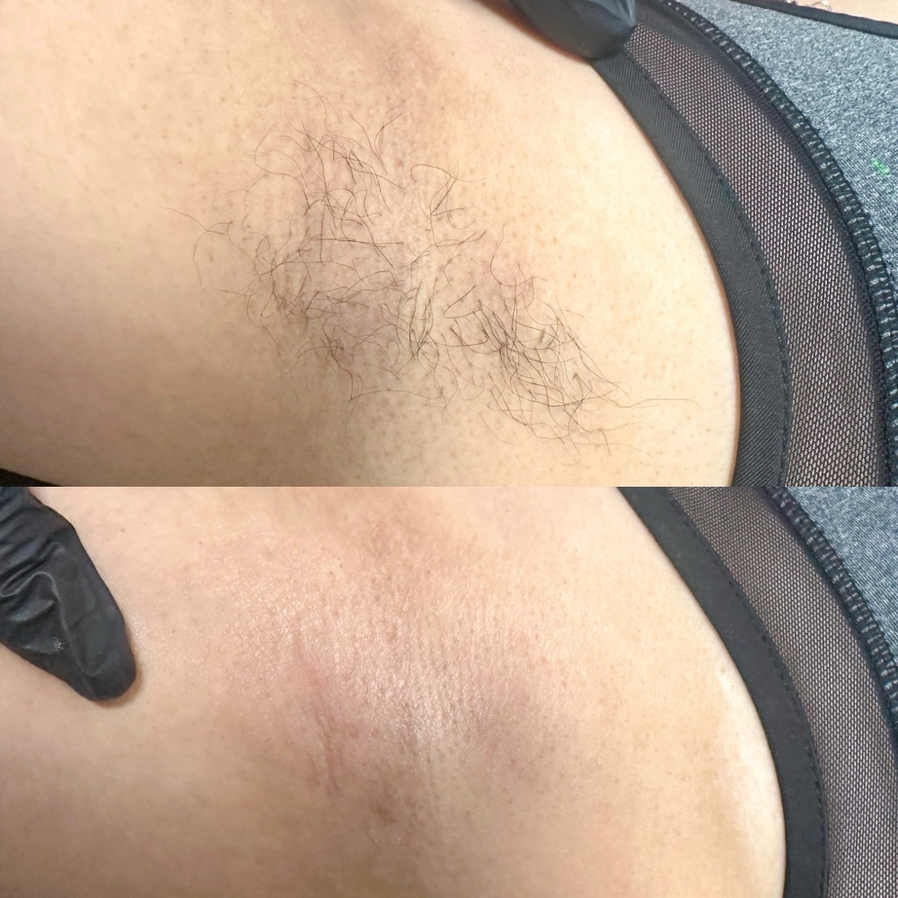 Underarm Wax at Chosen Esthetics in Pasadena, TX