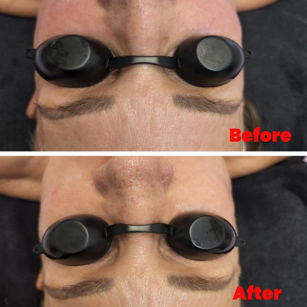 Sensitive Skin Treatment