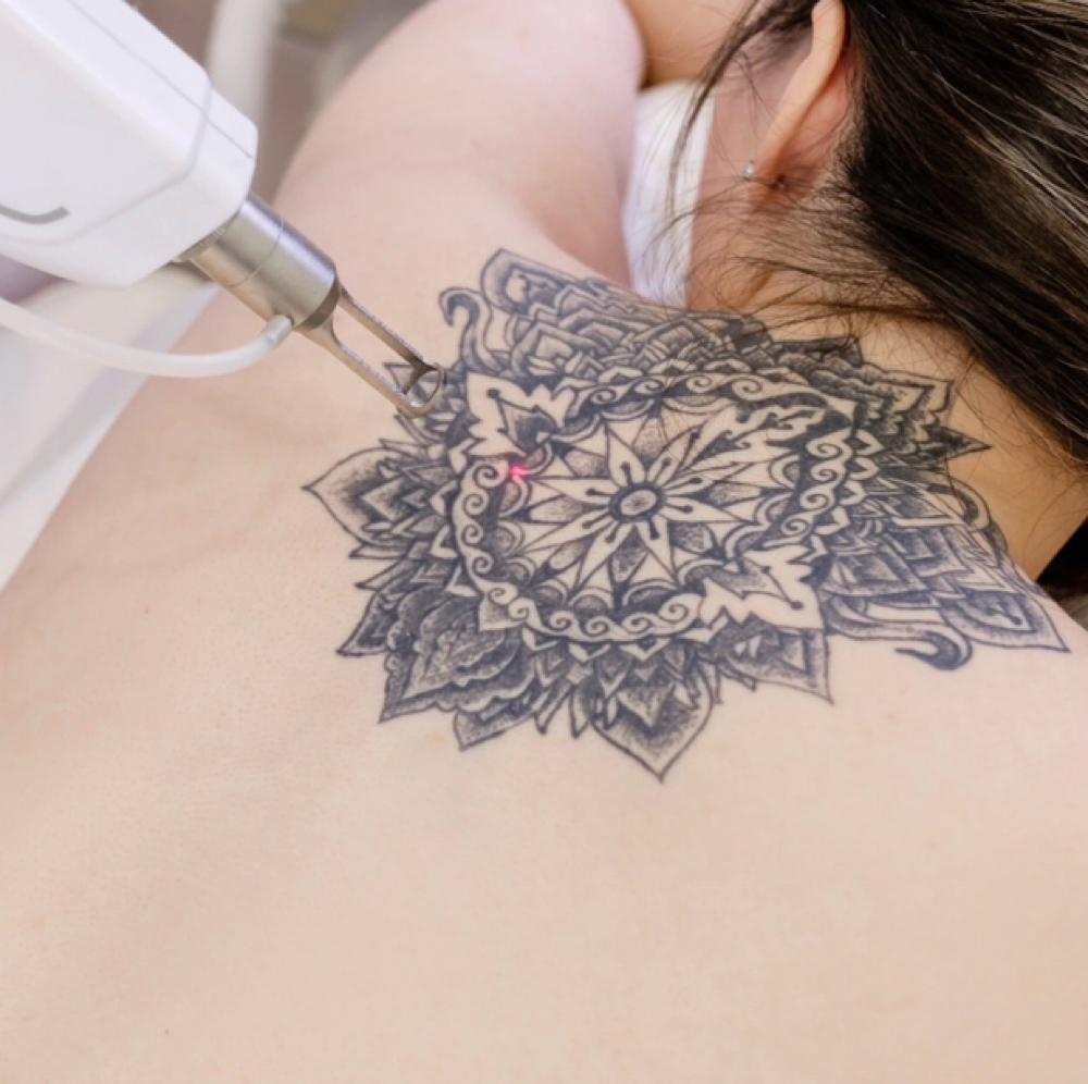 Laser Tattoo Removal - Large Area at NICHÉ in Lewisville, TX