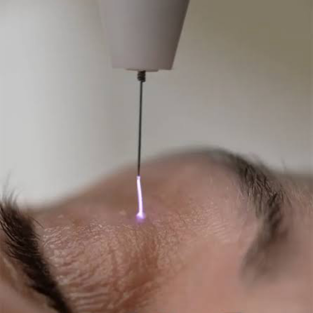 Cold Plasma Renewal at LĀ BEAUTY in Wilmington, MA