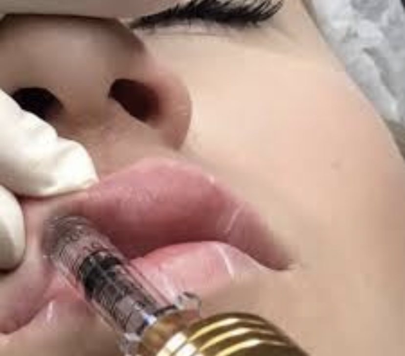 Needle-Less Lip Filler Course