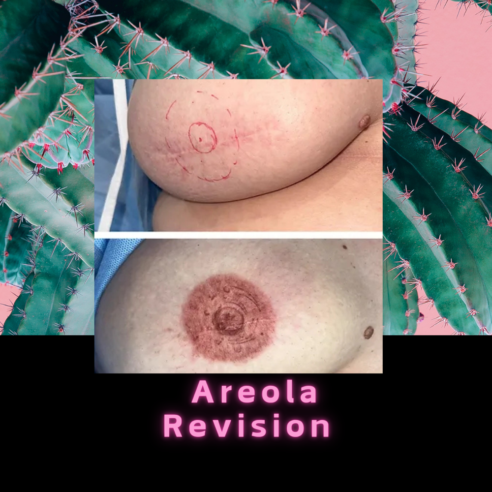 Areola Revision