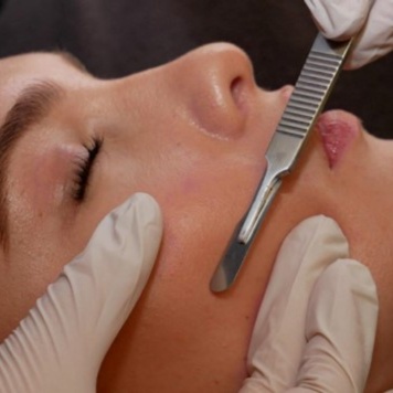 Dermaplaning treatment at Aesthetic Artistry by Renee V in Roswell, NM