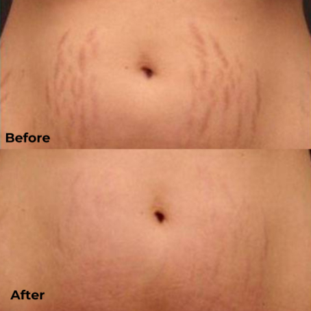 Micro Needling- Body Consultation