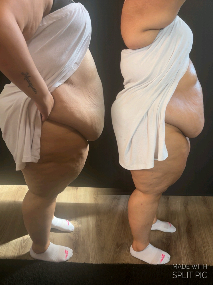 Ultrasonic Cavitation & wood therap at Runway Esthetics in Racine, WI