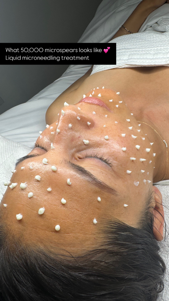 Cellstory Liquid Microneedling
