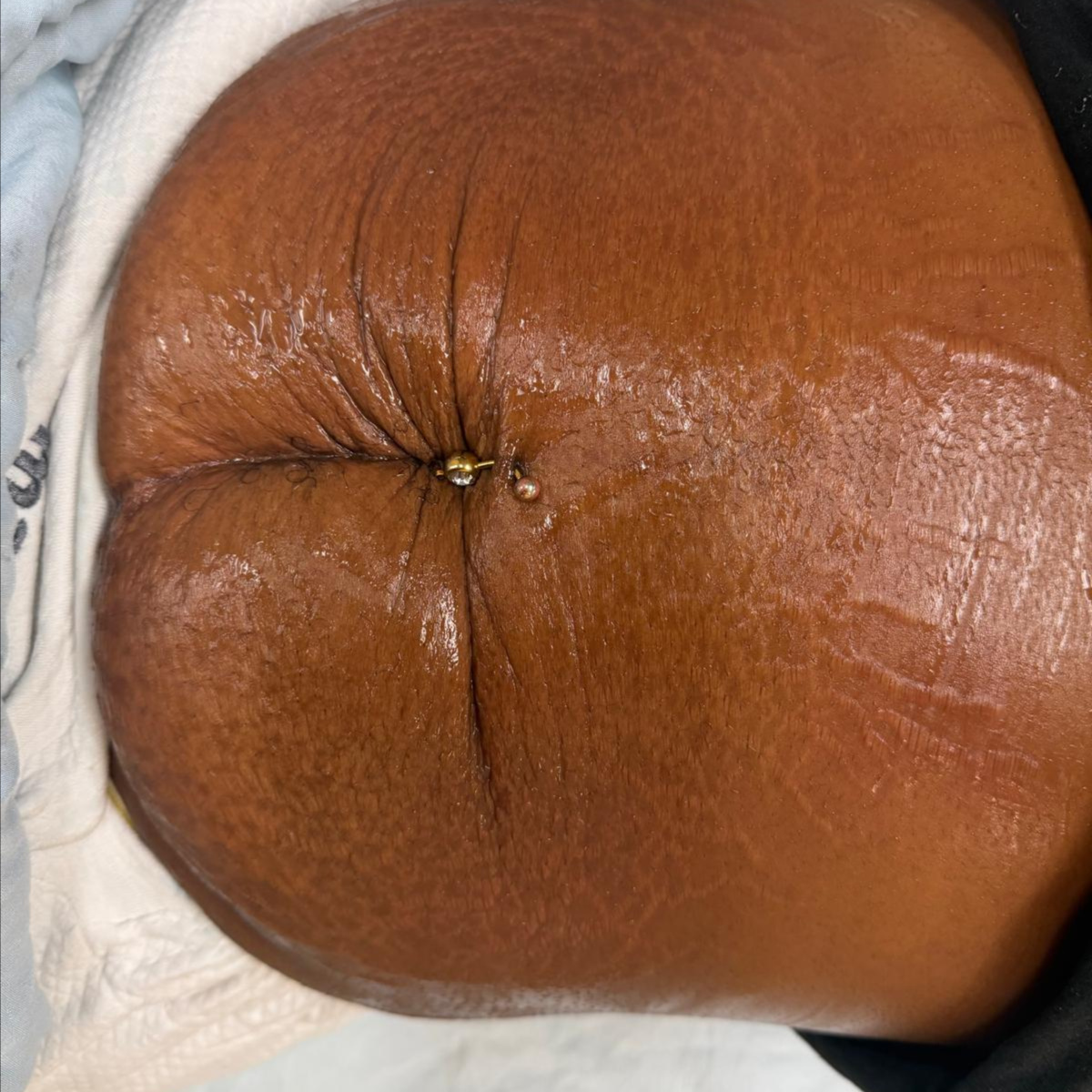 Chemical Peel at Kerala Ayurveda Panchakarma Center LLC in brandon, FL