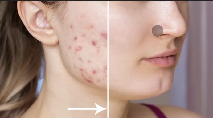 Acne Peel