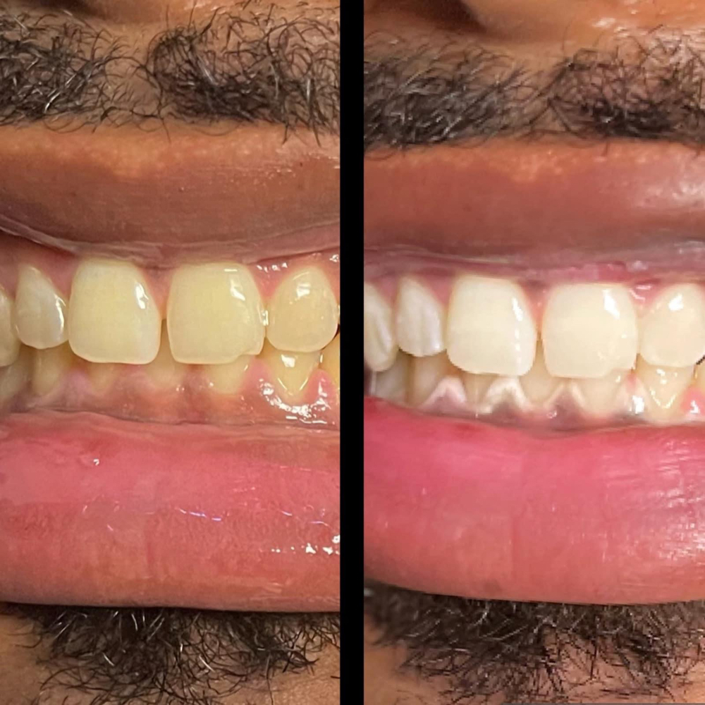 Teeth whitening an hour