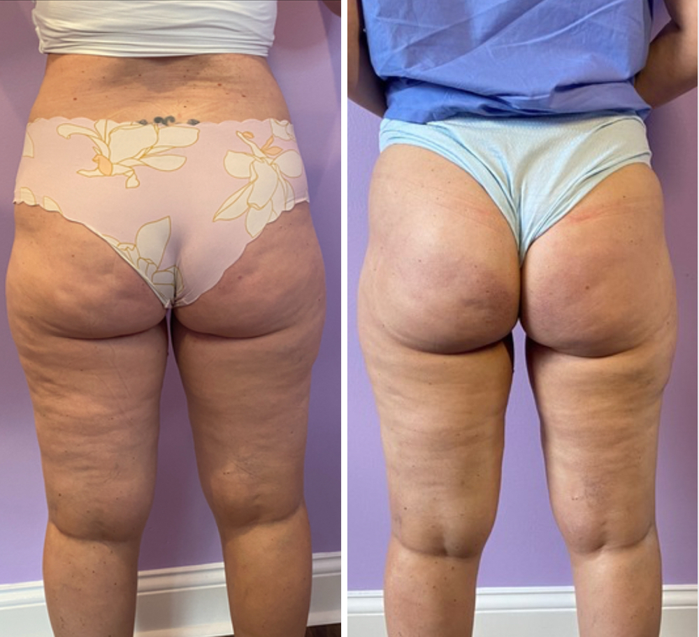 Cellulite Removal (Front Or Back)