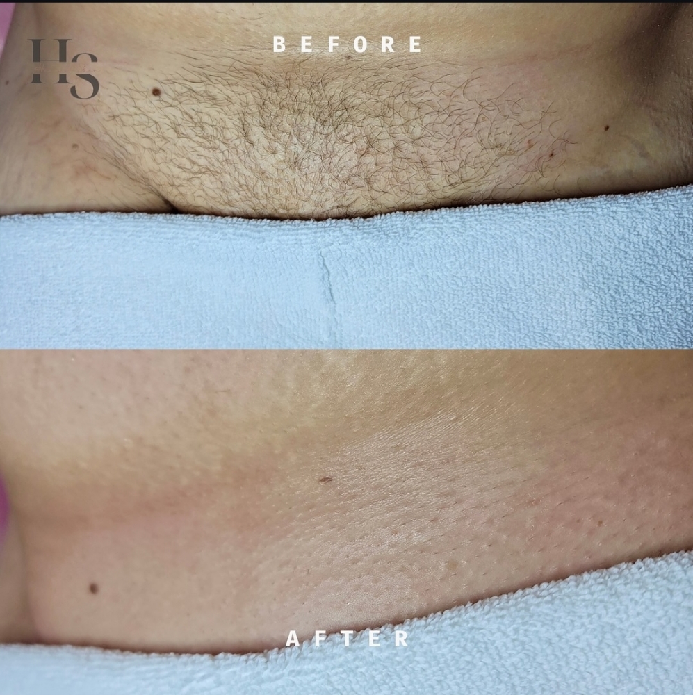 Brazilian Wax at Haus Of Skin in Burleson, TX