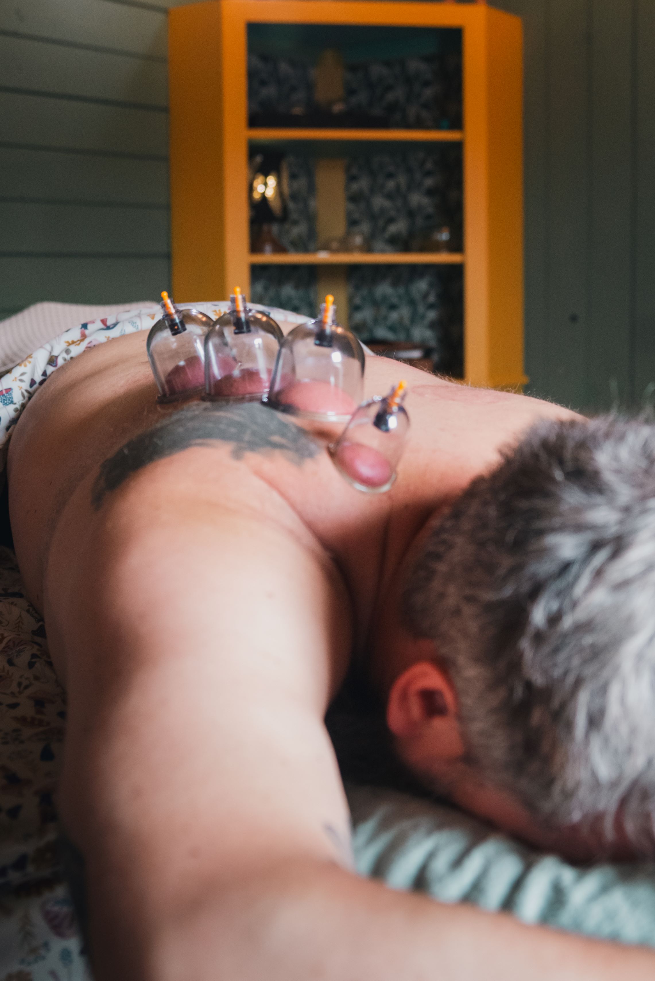 Cupping therapy
