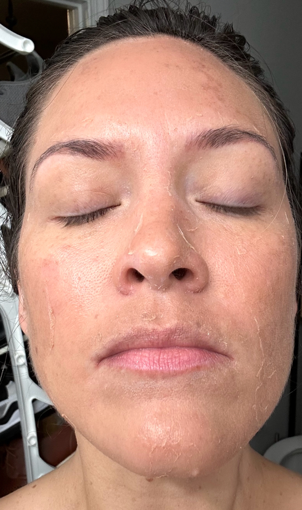 Perfect DermaPeel