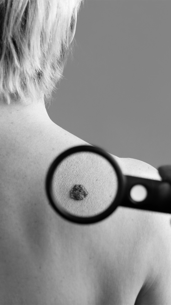DPN/Skintag/Seborrheic Keratosis