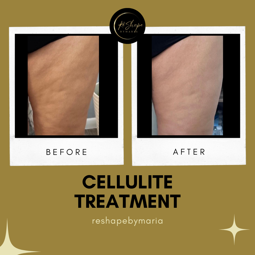 Cellulite Treatment