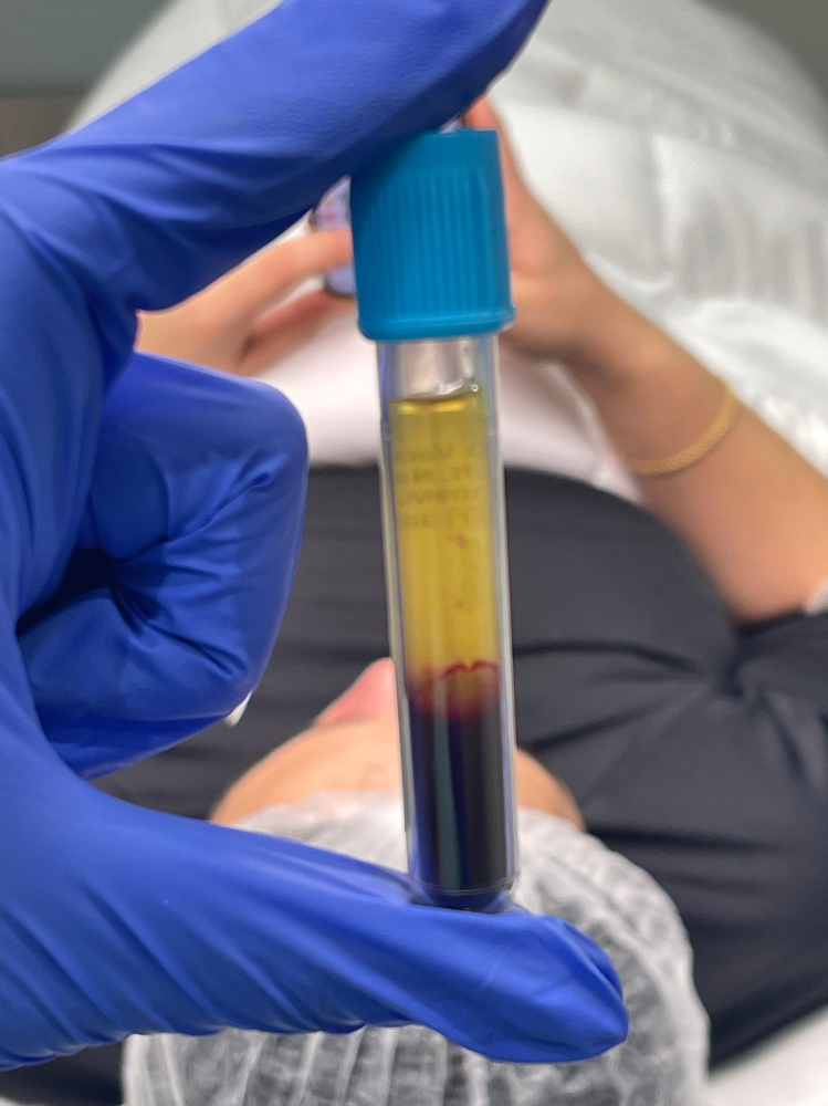 PLATELE RICH PLASMA/PLASMA RICO EN