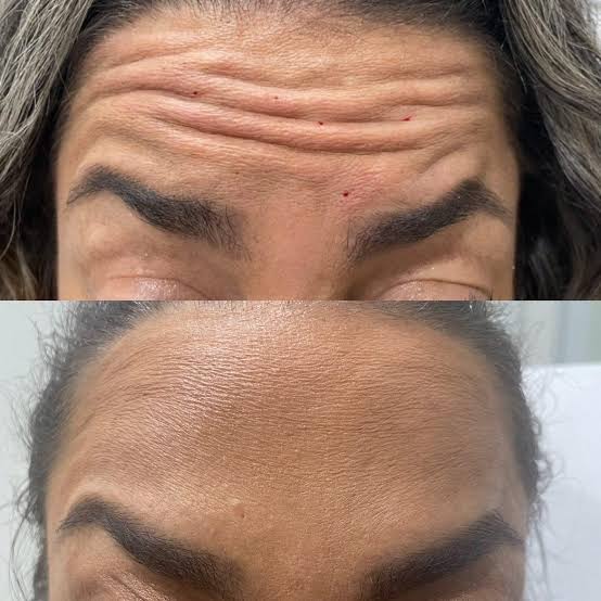 Frontalis •Forehead Treatment• at Glam X Sam MedBeauty in Andrews, TX