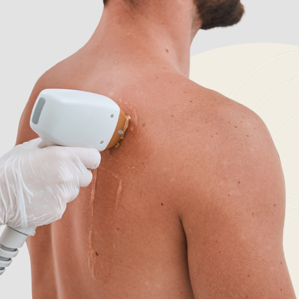 Shoulders Laser - 5 Sessions at Blessed & Bare Laser Studio in New York, NY