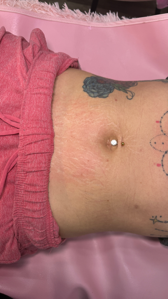 Stomatch Strip at Rose Beauty Bar | LLC in Lewisville, TX