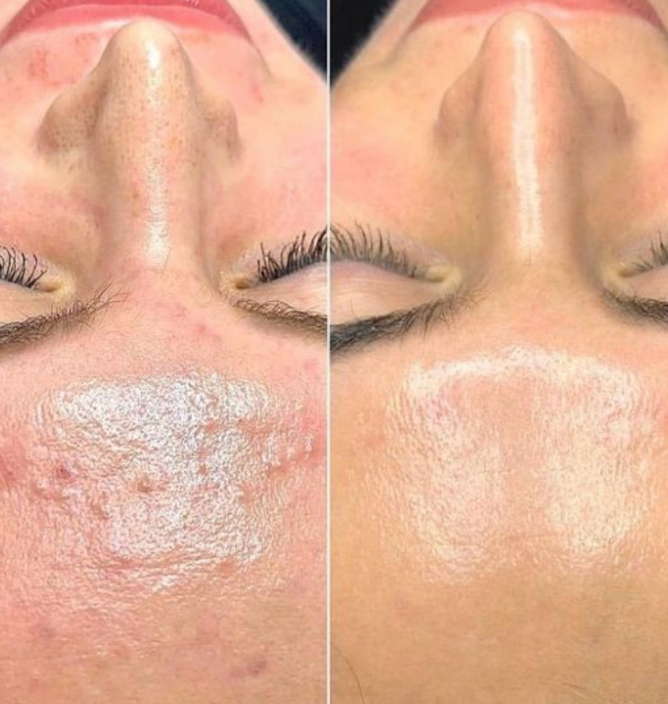 Progressive Peel