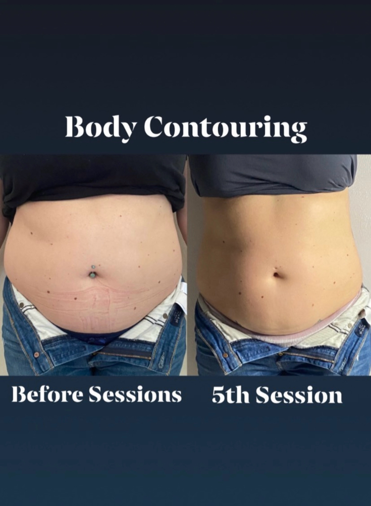 Body Contouring Package Of 5