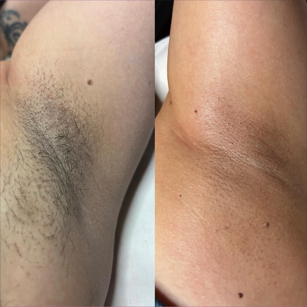 Underarm Wax