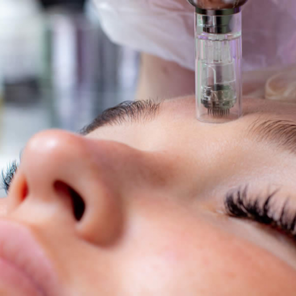 MicroNeedling at Revive Wellness in El Paso, TX