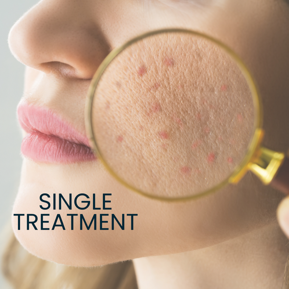 IPL Acne Face Treatment at PRYSM LIGHT in West Burlington, IA