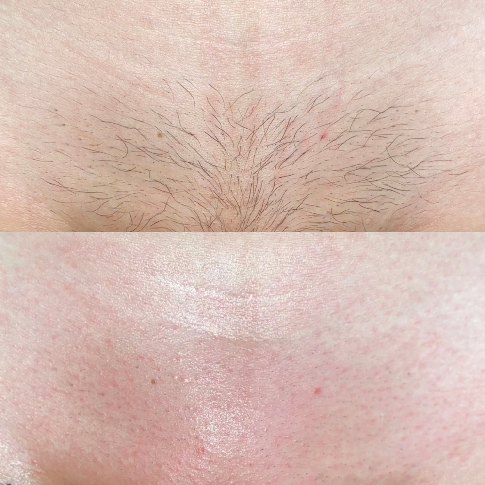 Brazilian Wax Maintenance (4-6wk)