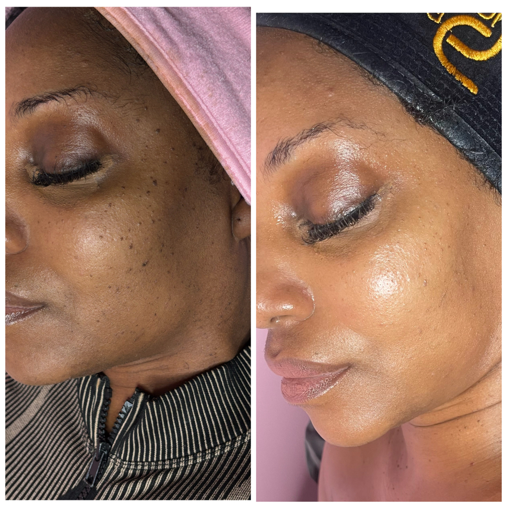 Body Tags Removal at Clinical Complexions in Merrillville, IN
