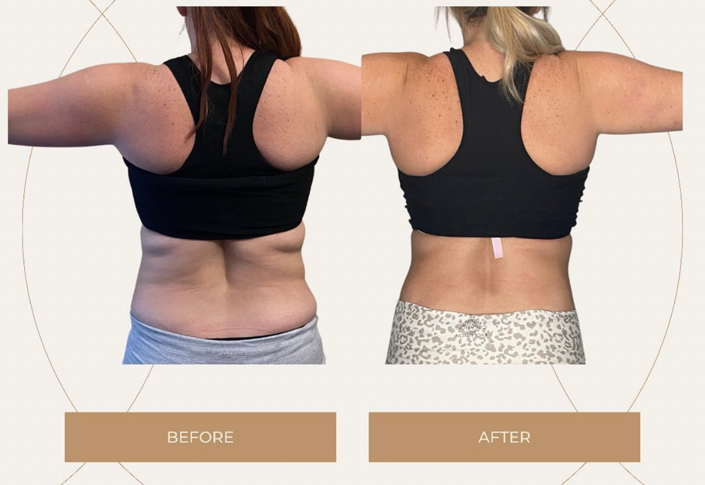Body Skin Tightening