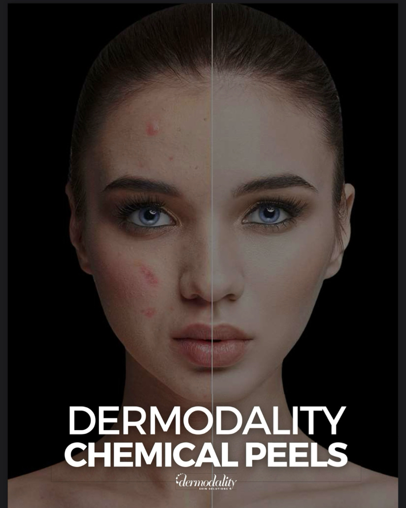 Chemical Exfoliation