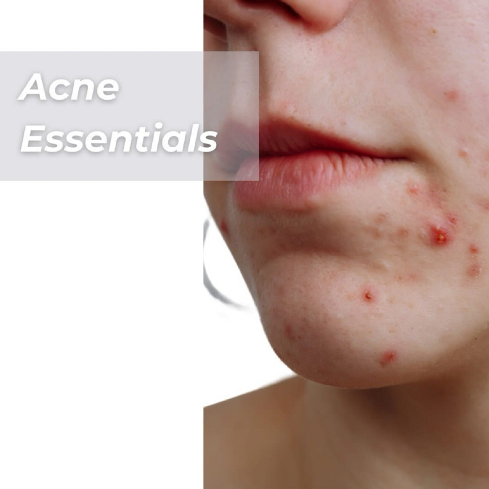 Acne Maintenance - Program Member at Holistic Skin Center in Edgewater, FL