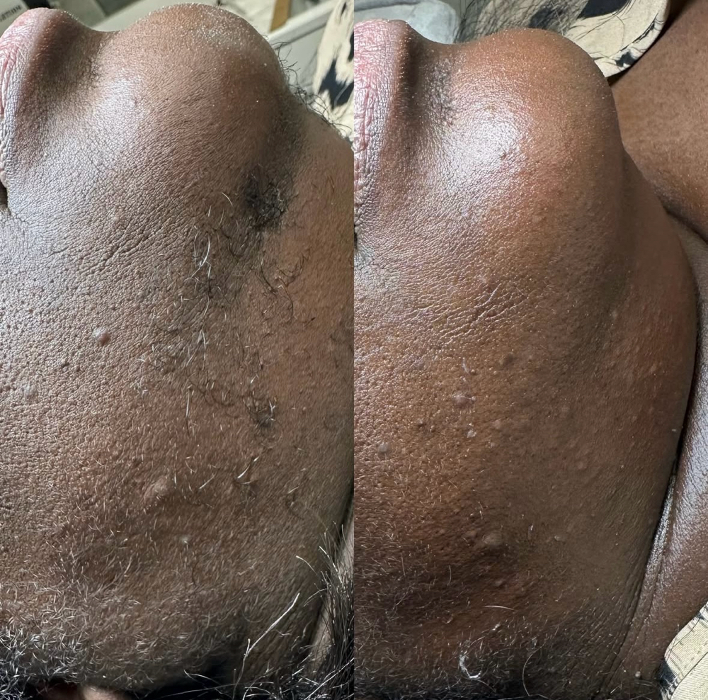 Chin Wax