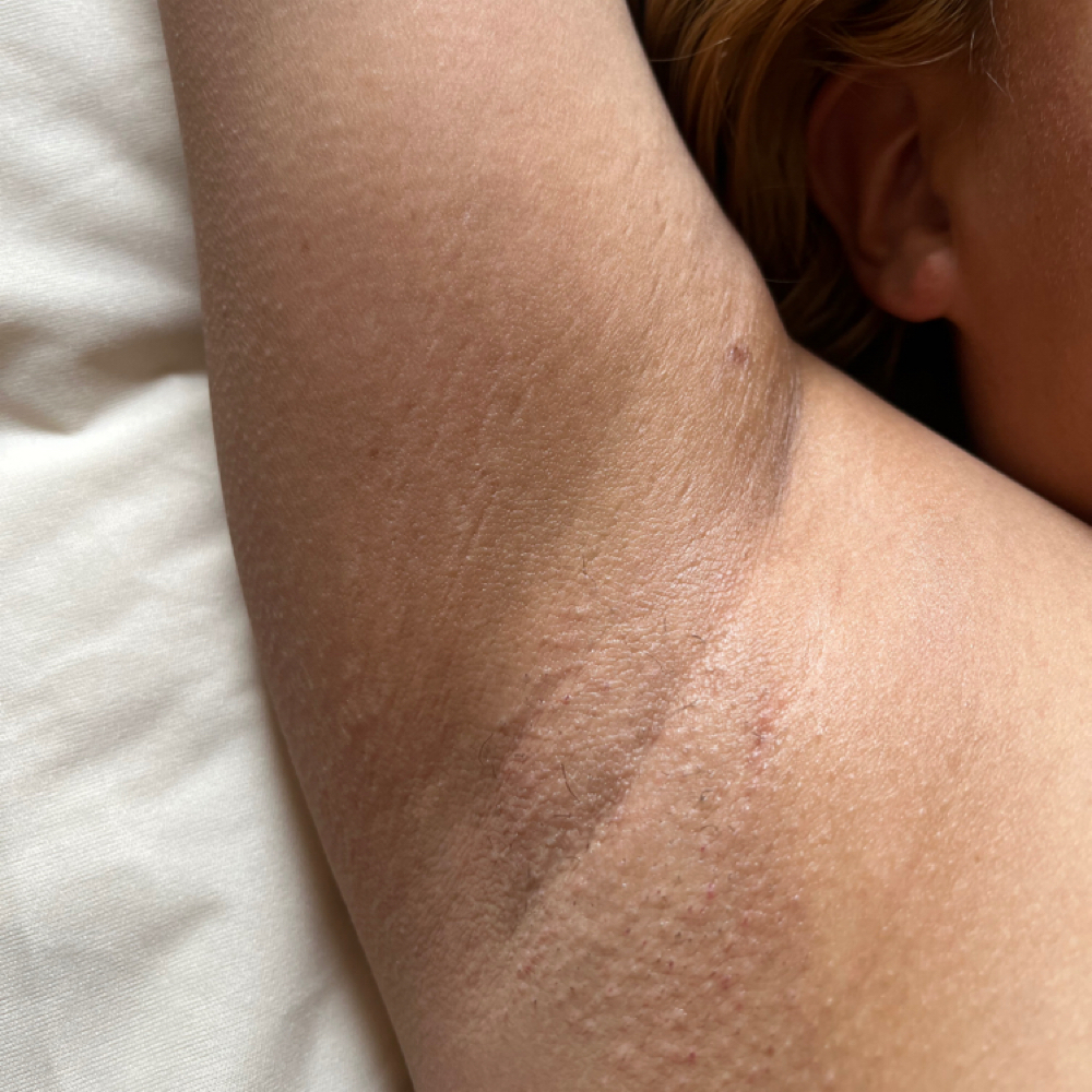 Underarm Perfection at Bloom Beauty Esthetics in Salt Lake City, UT