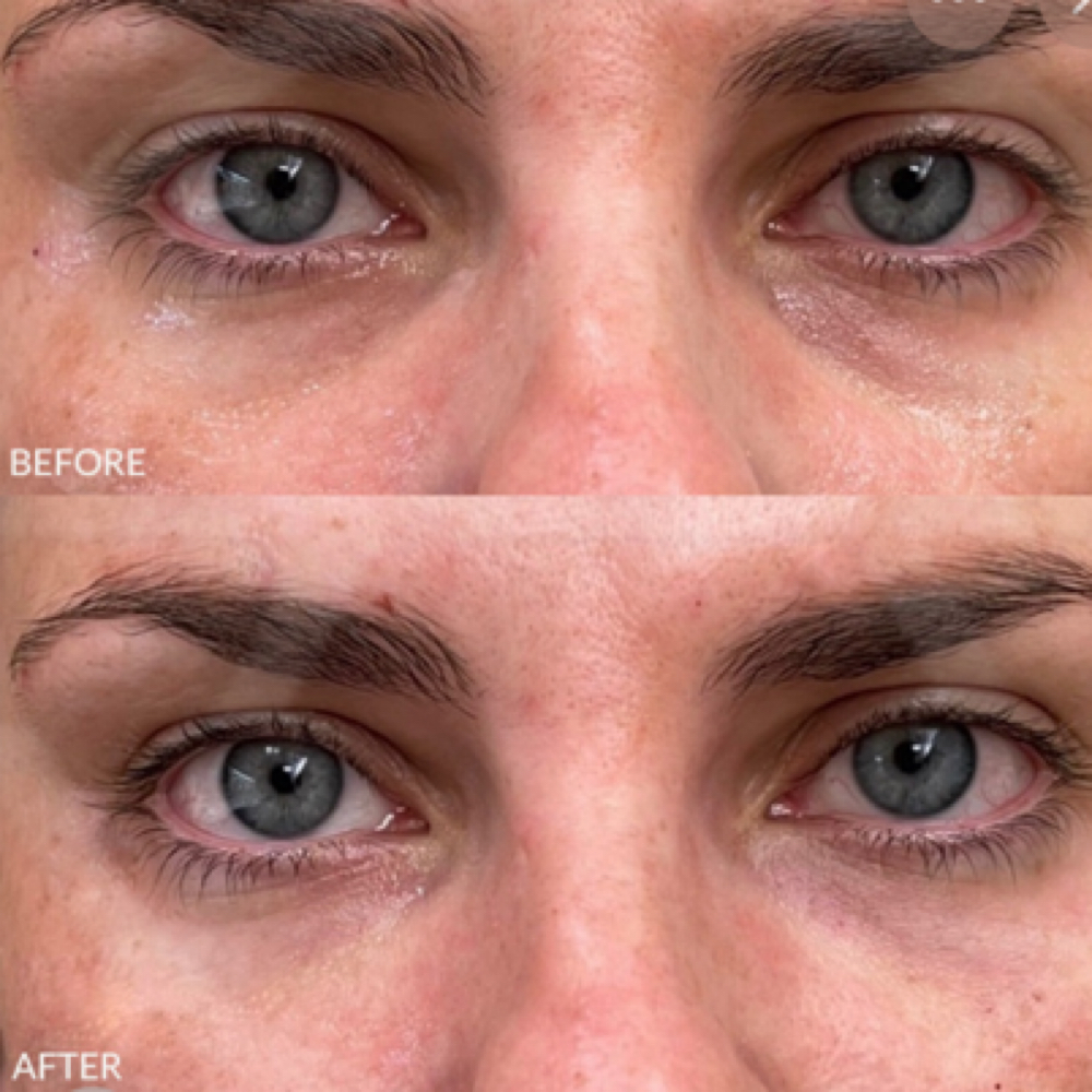 Collagen Eye Treatment at Esthetics With Michaela in Vidalia, LA