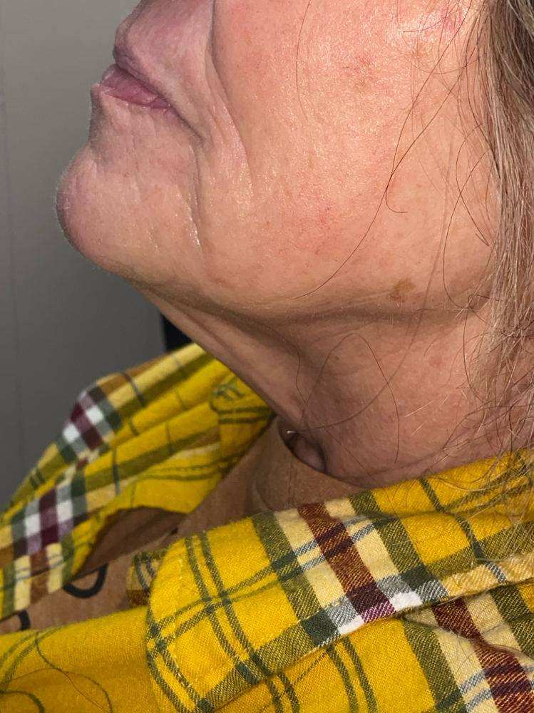 RF Turkey Neck Maintenance