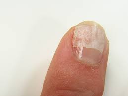 Nail Repair