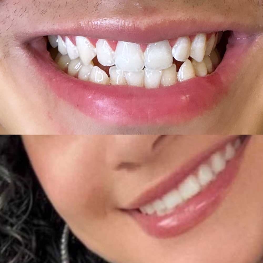 Brighten your smile together!