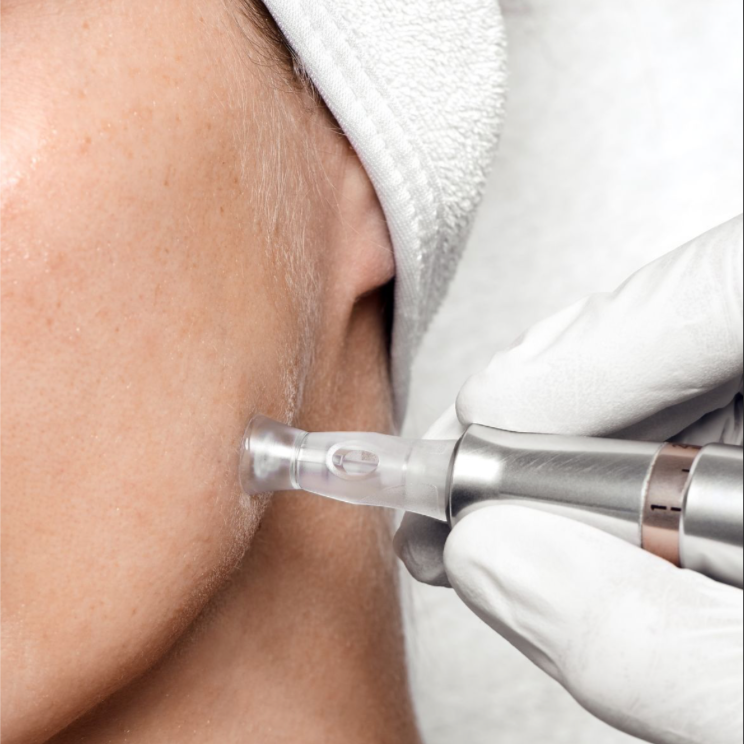 Microneedling at Cowgirl Casanova Aesthetics in Donnelly, ID