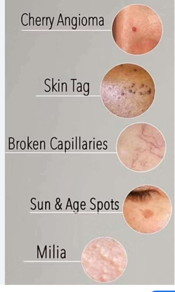 Skin classic - age spot