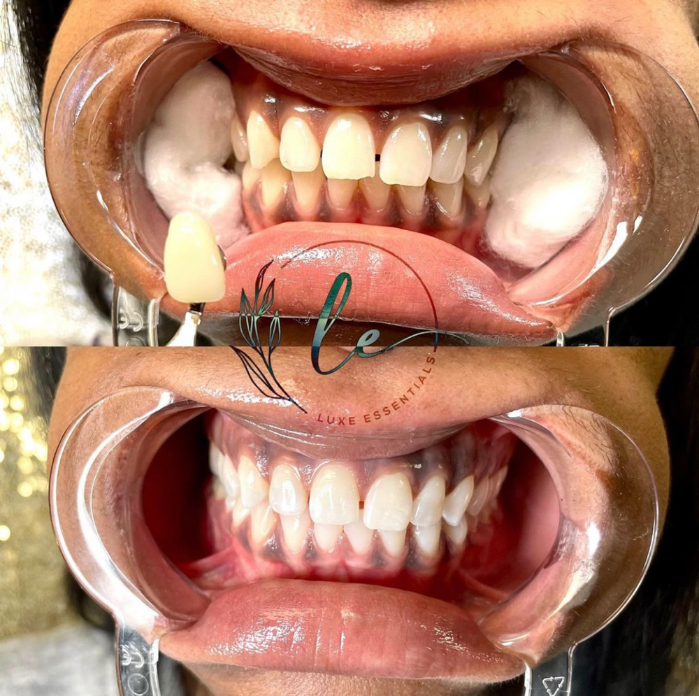 Teeth Whitening