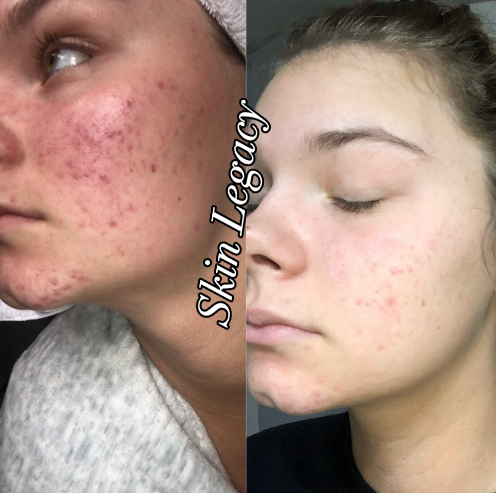 Acne Bootcamp