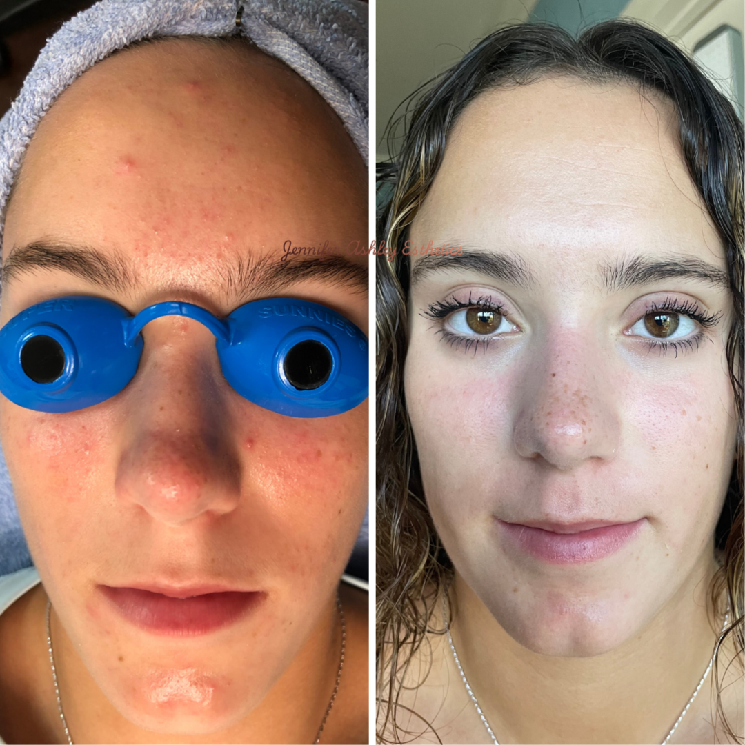 Rosacea & Redness Reset Program at Jennifer Ashley Esthetics in Seminole, FL