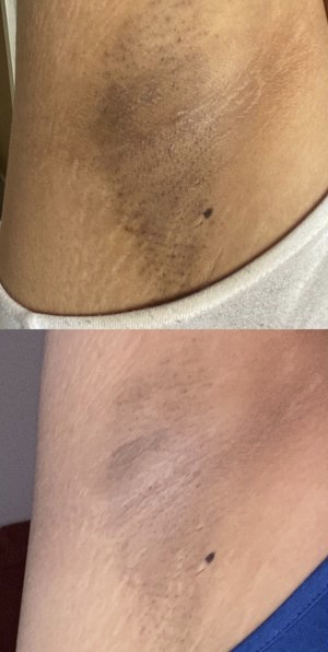 Underarms Skin Lightning
