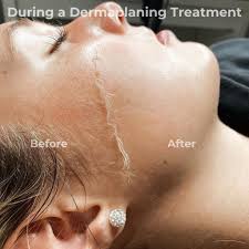 Dermaplaning (Add On)