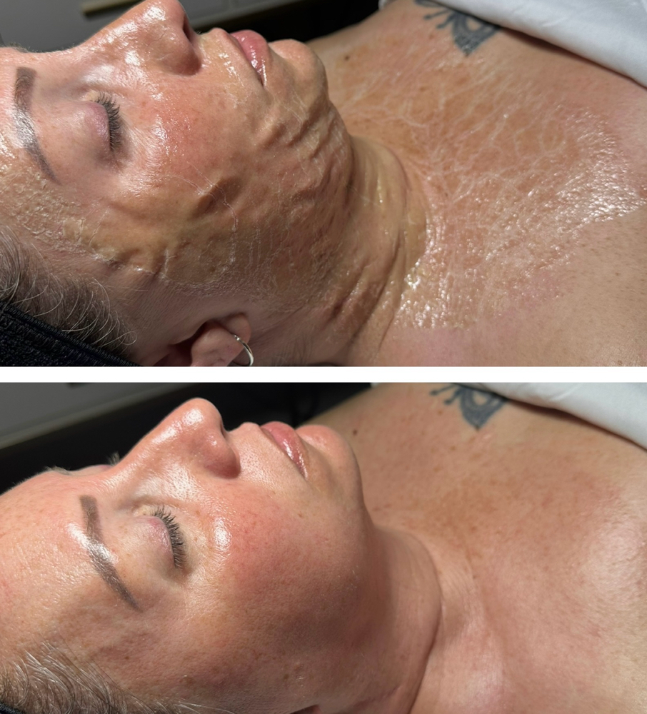 Firming Peptide “Zombie Facial”