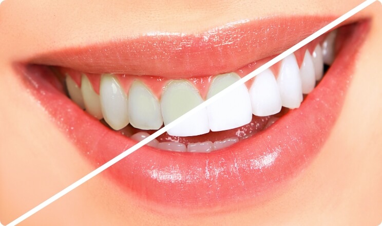 Initial Teeth Whitening Session