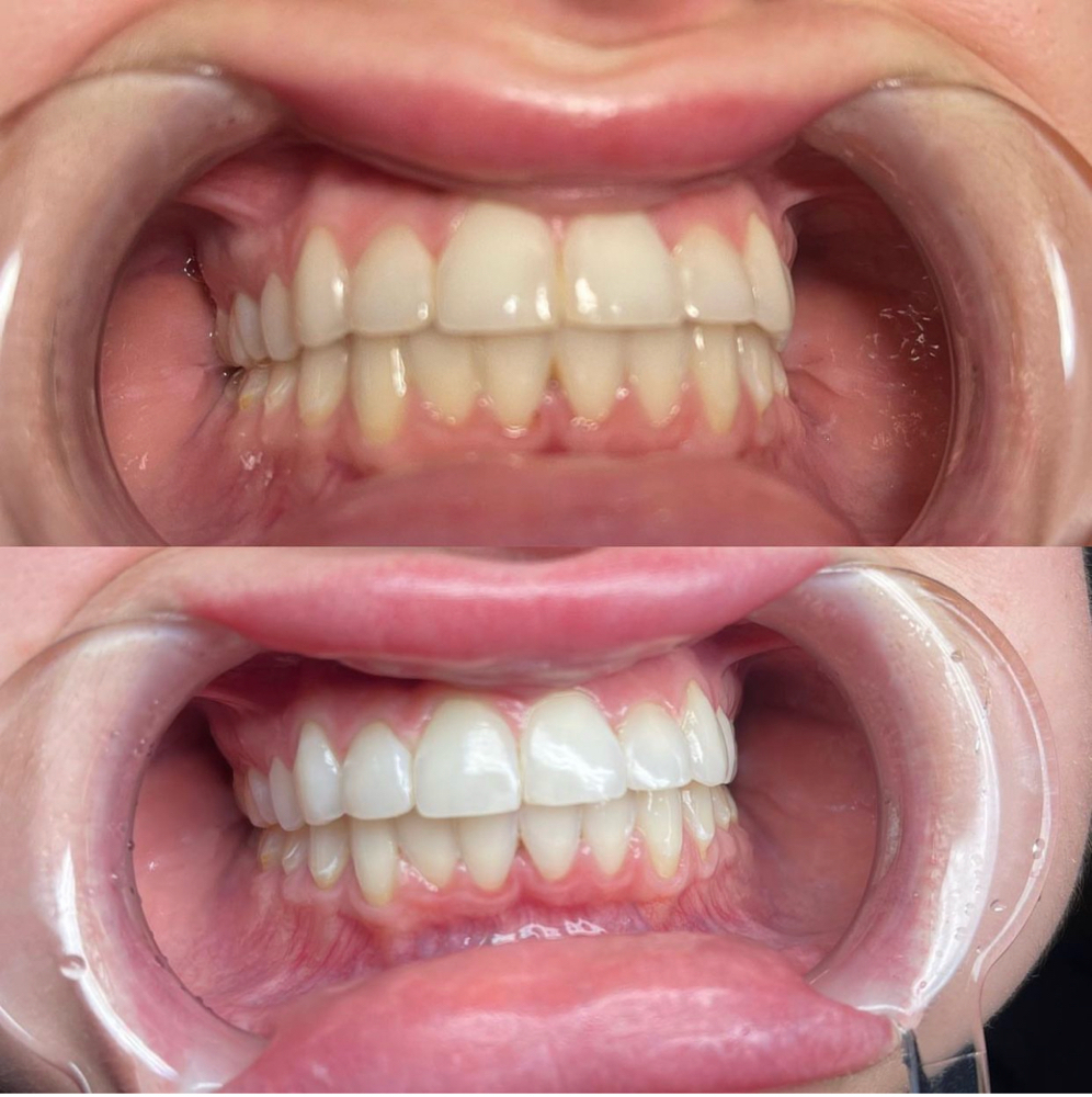 Teeth Whitening